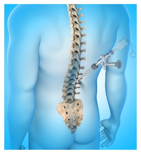 Endoscopic Outpatient Spine Surgery