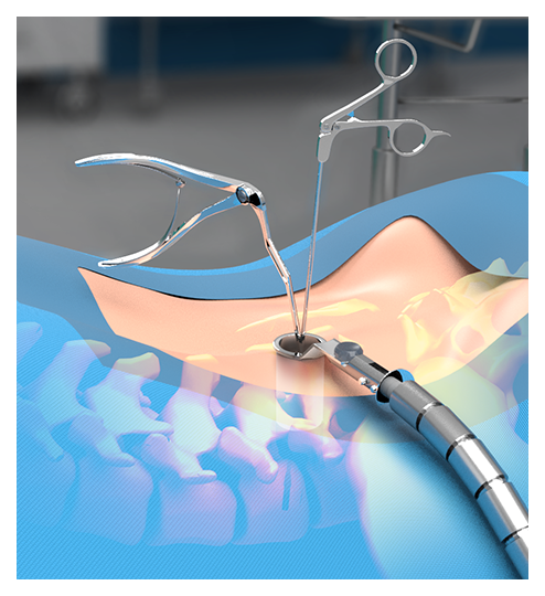  Minimally Invasive Spine Surgery